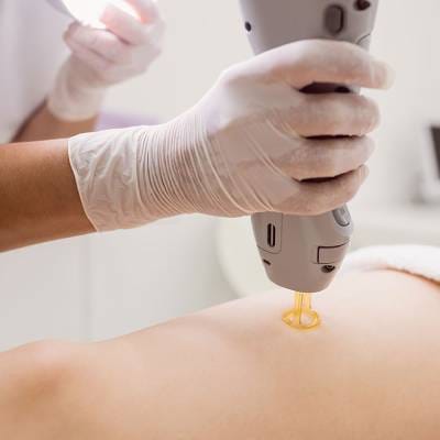 LASER HAIR REMOVAL